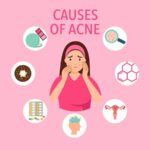 Causes of Acne and How to Manage It Effective Solutions for Clear Skin