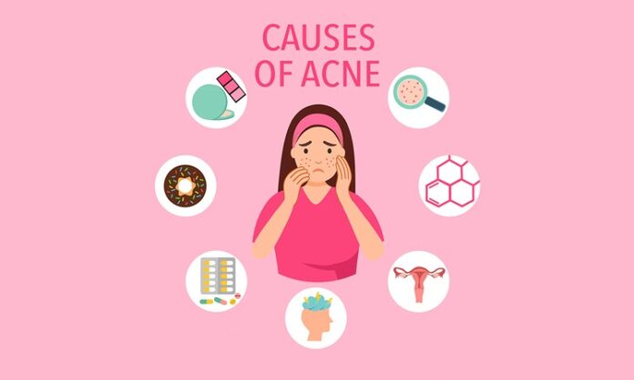 Causes of Acne and How to Manage It Effective Solutions for Clear Skin