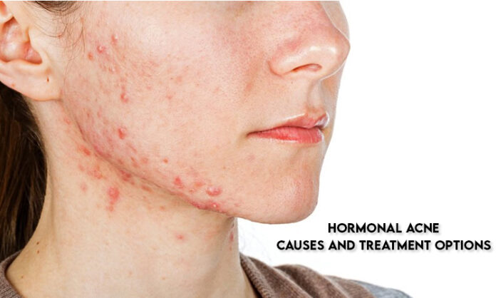 Hormonal Acne: Causes and Treatment Options