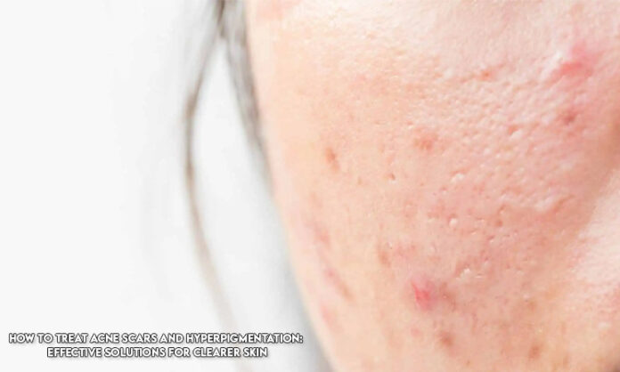 How to Treat Acne Scars and Hyperpigmentation: Effective Solutions for Clearer Skin