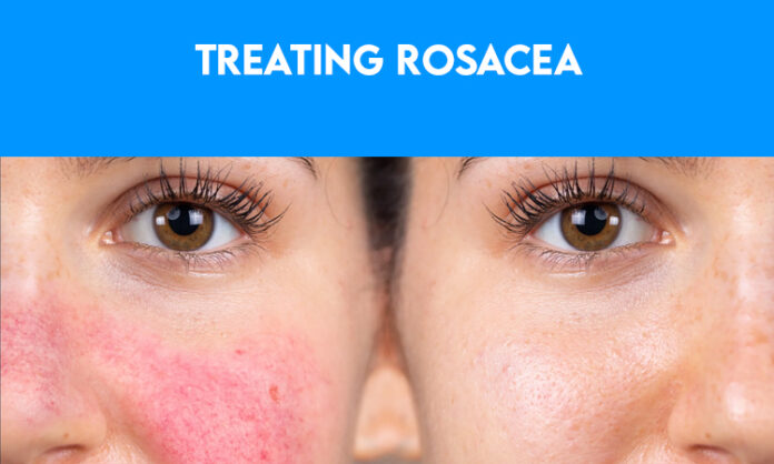 Treating Rosacea: The Ultimate Guide for Sensitive Skin